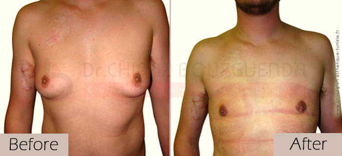 Gynecomastia-before-after-face-abroad-tunisia-patient5