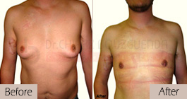 Gynecomastia-before-after-face-abroad-tunisia-patient5