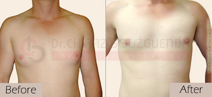 Gynecomastia-before-after-face-abroad-tunisia-patient6