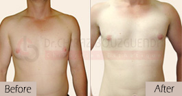 Gynecomastia-before-after-face-abroad-tunisia-patient6