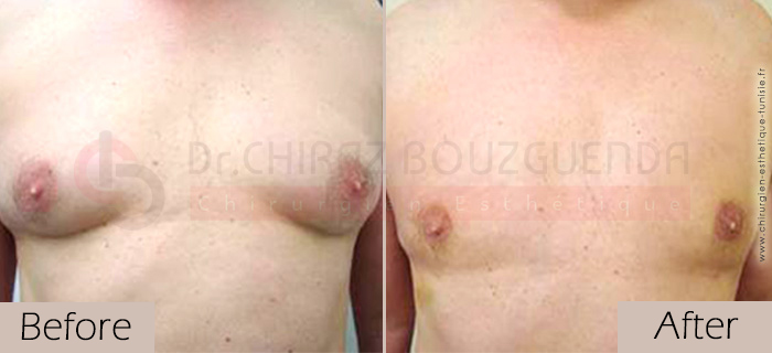   Gynecomastia-before-after-face-abroad-tunisia-patient7