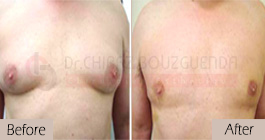   Gynecomastia-before-after-face-abroad-tunisia-patient7