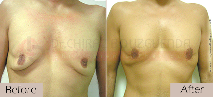   Gynecomastia-before-after-face-abroad-tunisia-patient8