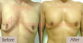   Gynecomastia-before-after-face-abroad-tunisia-patient8