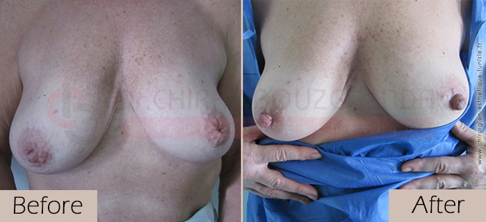 Inverted-nipples-face-large-abroad-tunisia-patient1