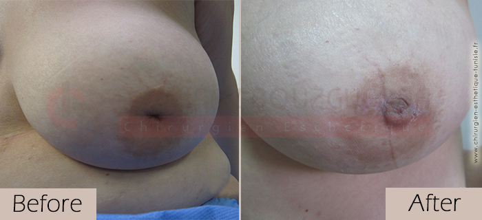 Inverted-nipples-face-large-abroad-tunisia-patient3