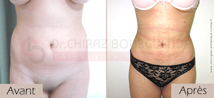 Liposuction-before-after-abroad-tunisia-patient1