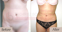 Liposuction-before-after-abroad-tunisia-patient1