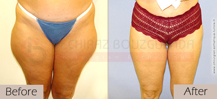 Liposuction-before-after-abroad-tunisia-patient10