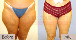 Liposuction-before-after-abroad-tunisia-patient10