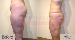 Liposuction-before-after-abroad-tunisia-patient11