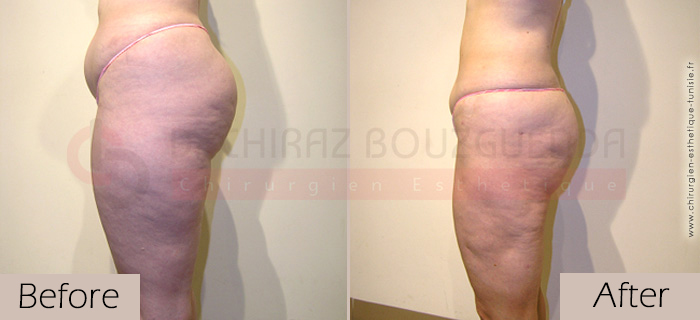 Liposuction-before-after-abroad-tunisia-patient11