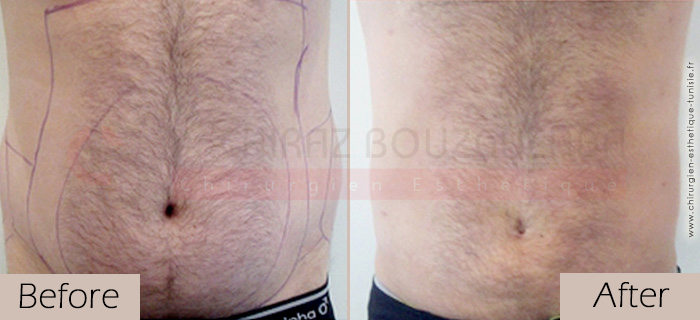 Liposuction-before-after-abroad-tunisia-patient12