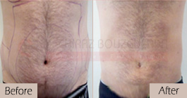 Liposuction-before-after-abroad-tunisia-patient12