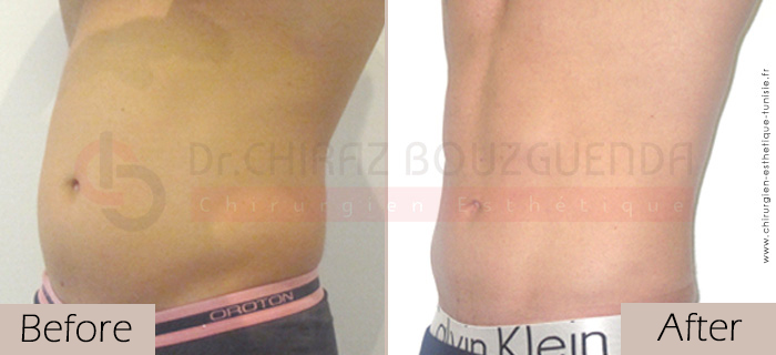 Liposuction-before-after-abroad-tunisia-patient13