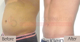 Liposuction-before-after-abroad-tunisia-patient13