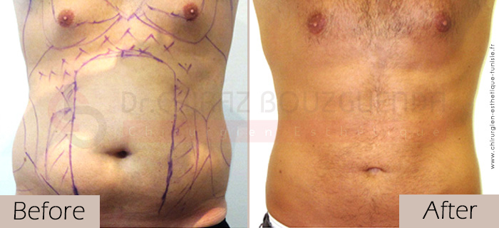 Liposuction-before-after-abroad-tunisia-patient14