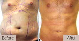 Liposuction-before-after-abroad-tunisia-patient14