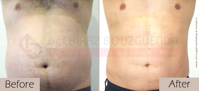 Liposuction-before-after-abroad-tunisia-patient15