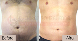 Liposuction-before-after-abroad-tunisia-patient15