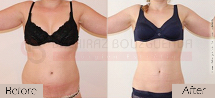 Liposuction-before-after-abroad-tunisia-patient2