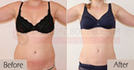 Liposuction-before-after-abroad-tunisia-patient2