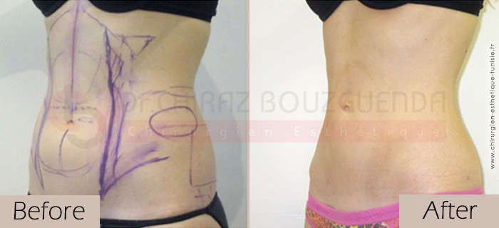 Liposuction-before-after-abroad-tunisia-patient3