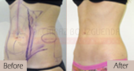 Liposuction-before-after-abroad-tunisia-patient3
