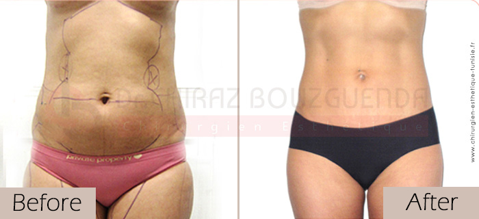 Liposuction-before-after-abroad-tunisia-patient4