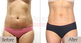 Liposuction-before-after-abroad-tunisia-patient4