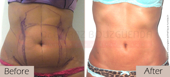 Liposuction-before-after-abroad-tunisia-patient5