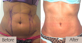 Liposuction-before-after-abroad-tunisia-patient5