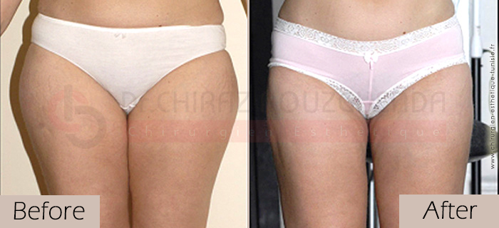 Liposuction-before-after-abroad-tunisia-patient6