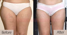 Liposuction-before-after-abroad-tunisia-patient6