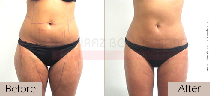 Liposuction-before-after-abroad-tunisia-patient7