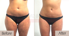 Liposuction-before-after-abroad-tunisia-patient7
