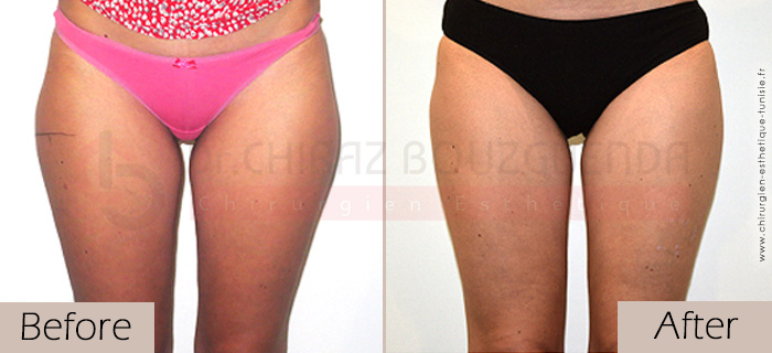 Liposuction-before-after-abroad-tunisia-patient8