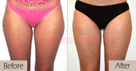 Liposuction-before-after-abroad-tunisia-patient8