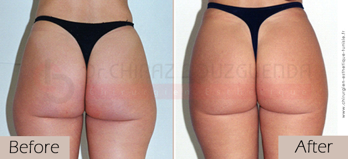 Liposuction-before-after-abroad-tunisia-patient9