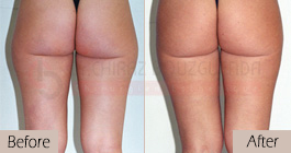 Liposuction-before-after-abroad-tunisia-patient9