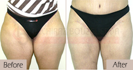 Thigh-lift -before-after-abroad-tunisia-patient1