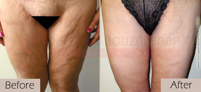 Thigh-lift -before-after-abroad-tunisia-patient2