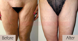 Thigh-lift -before-after-abroad-tunisia-patient2