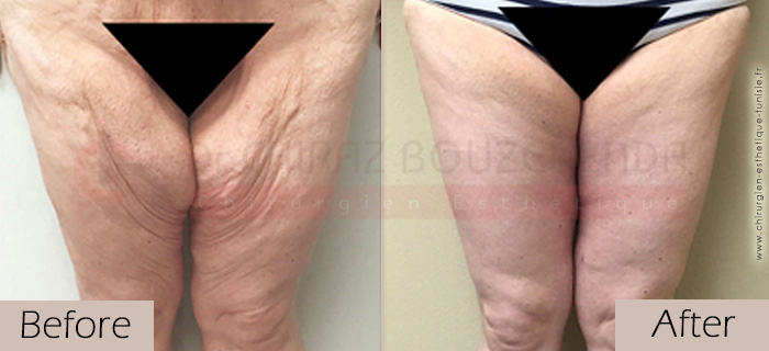 Thigh-lift -before-after-abroad-tunisia-patient3