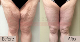Thigh-lift -before-after-abroad-tunisia-patient3
