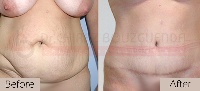 Tummy-tuck-before-after-abroad-tunisia-patient1