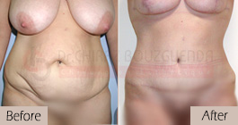 Tummy-tuck-before-after-abroad-tunisia-patient1