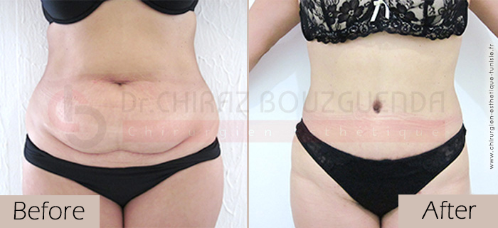 Tummy-tuck-before-after-abroad-tunisia-patient2