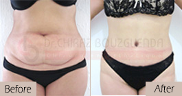 Tummy-tuck-before-after-abroad-tunisia-patient2