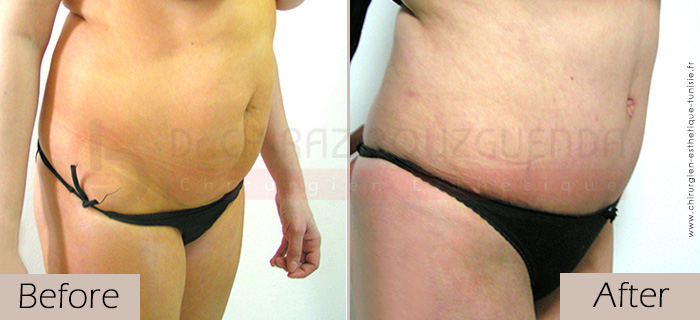 Tummy-tuck-before-after-abroad-tunisia-patient3